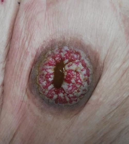 infected stoma